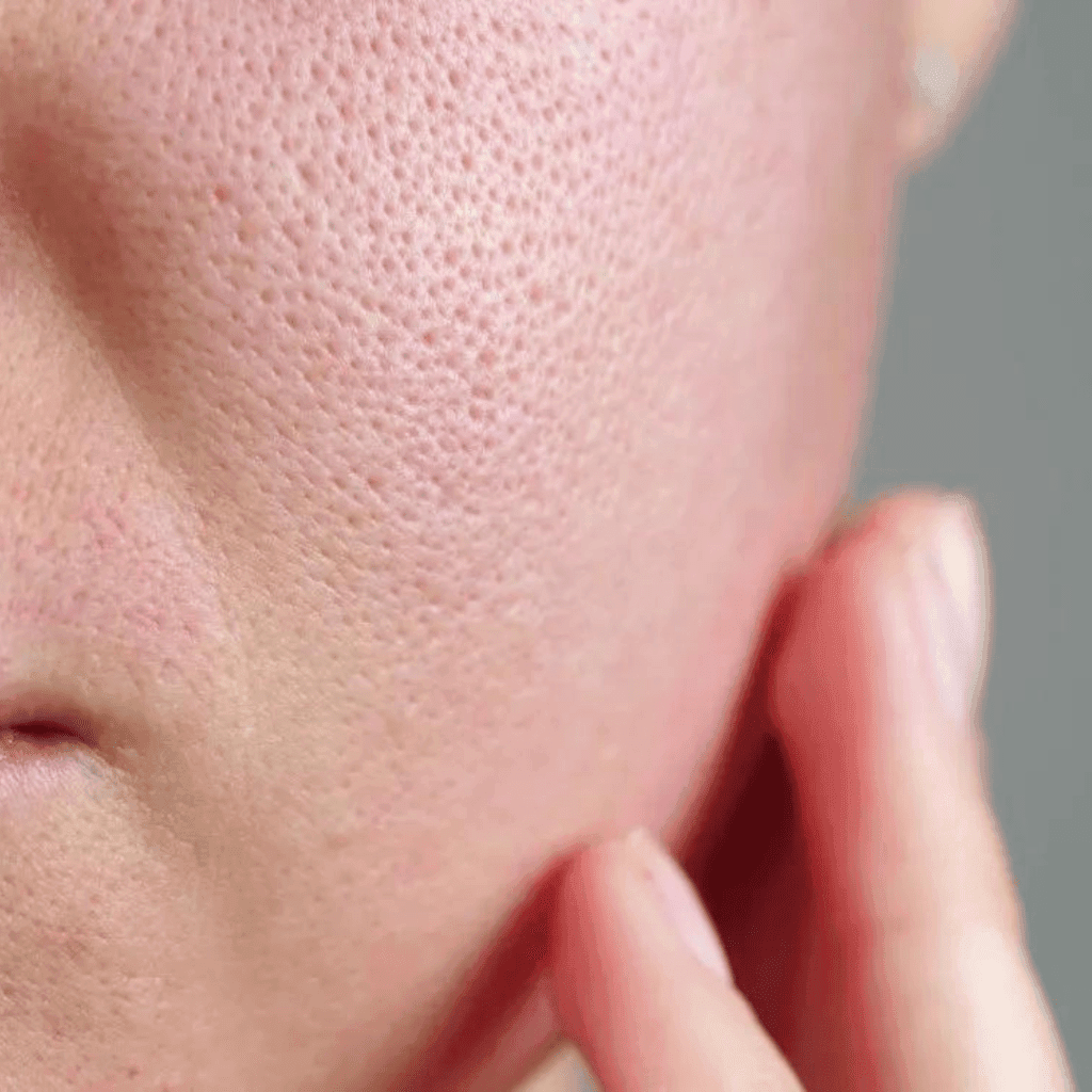 CO2 Fractional Laser it can reduce Enlarged Pores Hydrafacial Treatment PICO 450 LASER