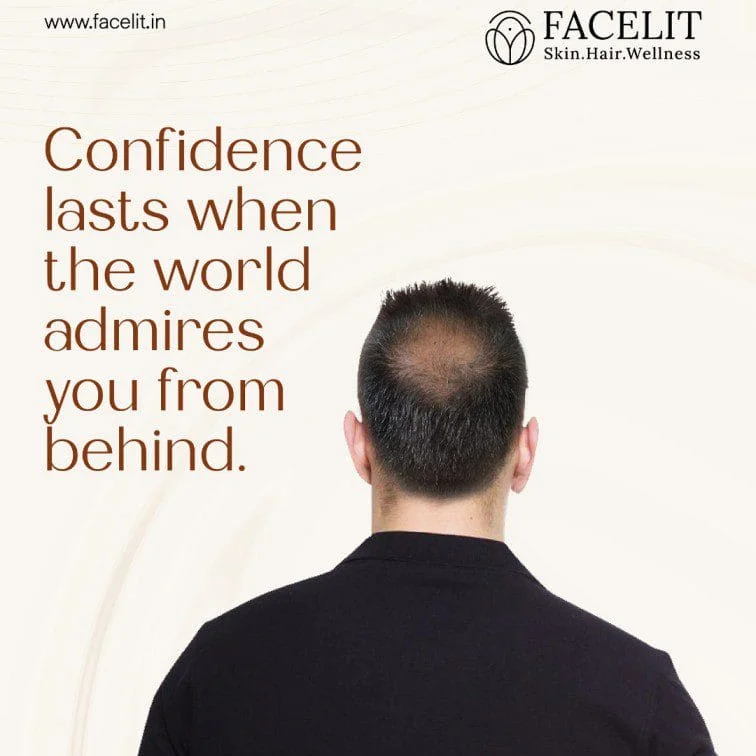 Best Hair Clinic in Trivandrum – Facelit Clinic