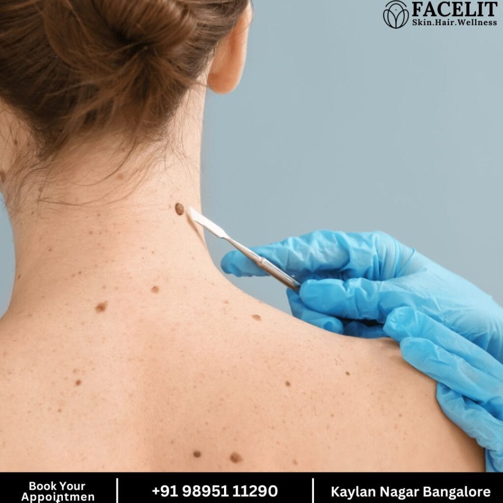 Skin Tag and Tan Removal in Bangalore