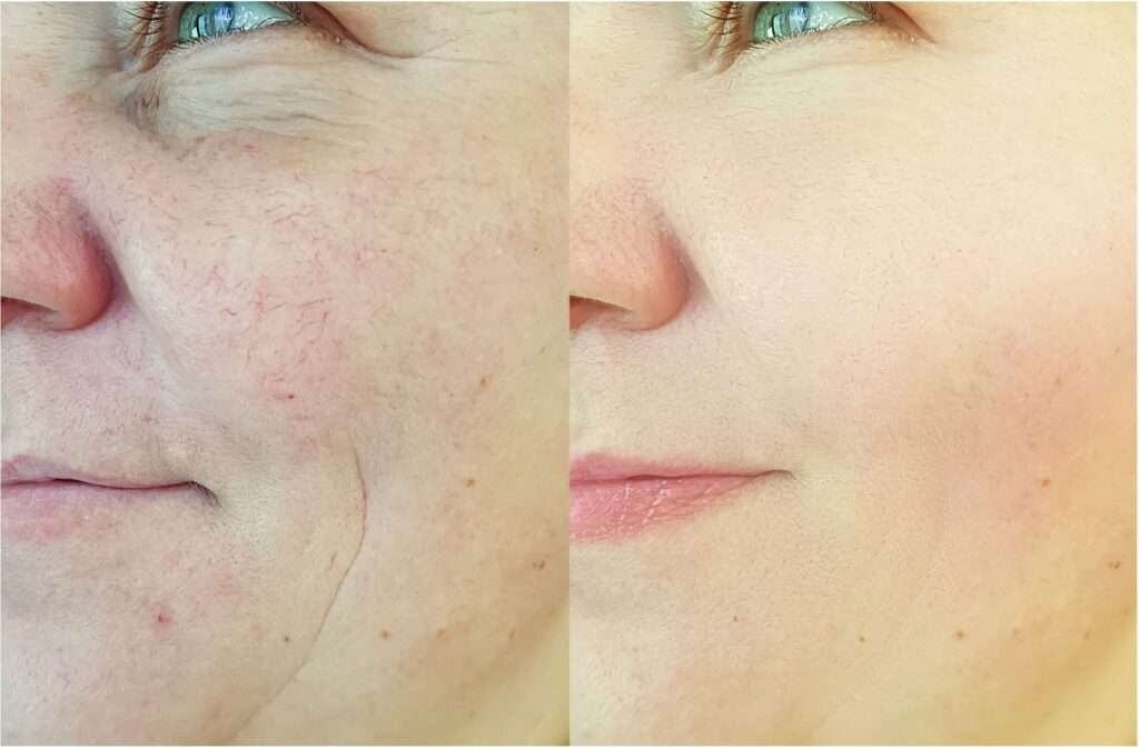 Microneedling Before and After Results taken by women for Fine Lines and Wrinkles treatment at facelit