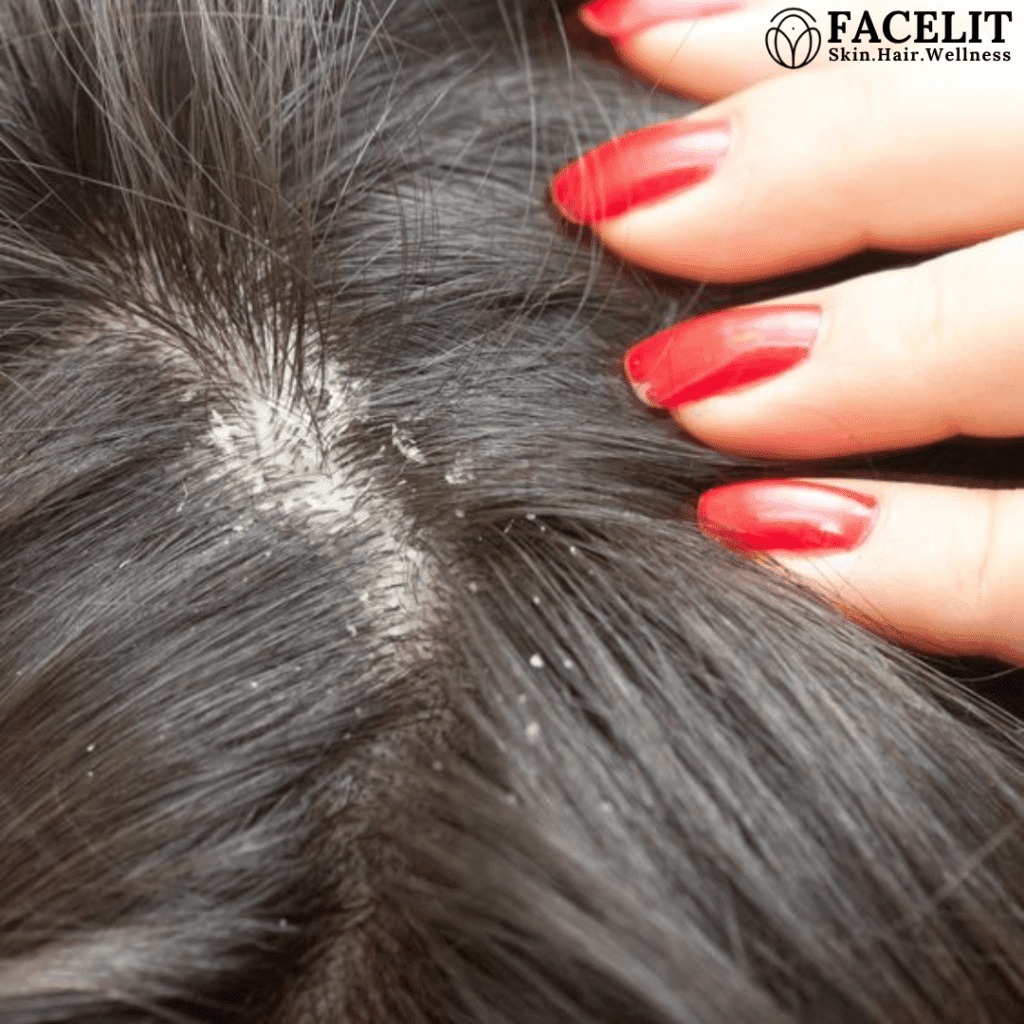 dandruff treatment done at facelit clinic