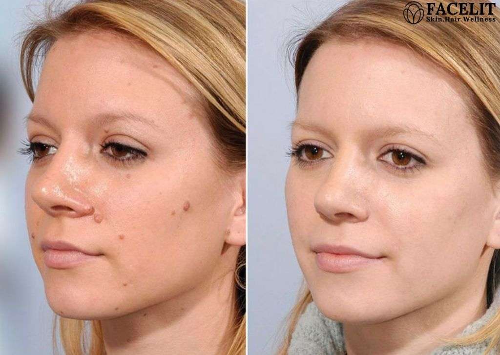 before and after image of an women with skin tag and tan