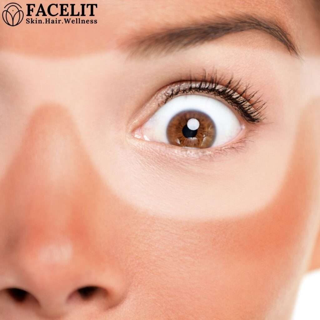 Best Skin Tag and Tan Removal in Trivandrum