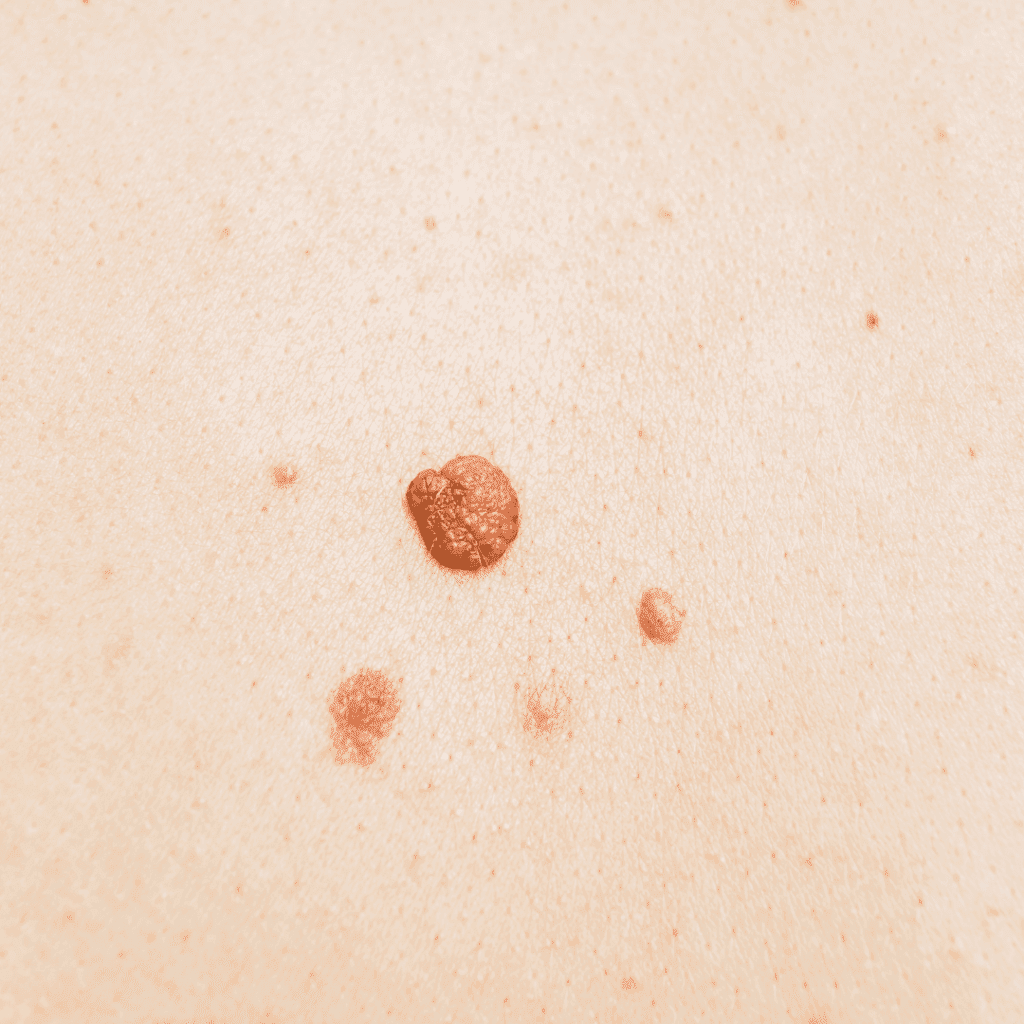 Skin Tag and Tan Removal in Bangalore done at facelit clinic
