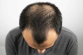 men facing hair loss