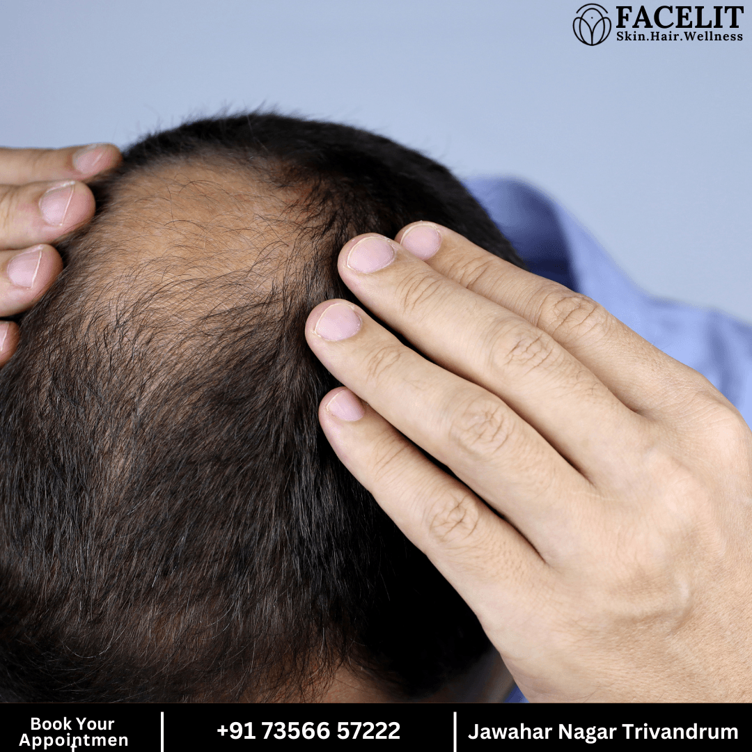 men hair loss treatment