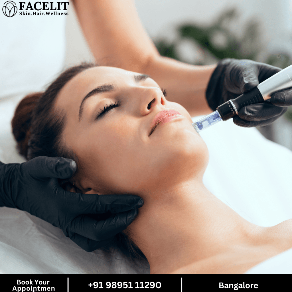 Microneedling with Dermapen for Fine Lines and Wrinkles in Bangalore