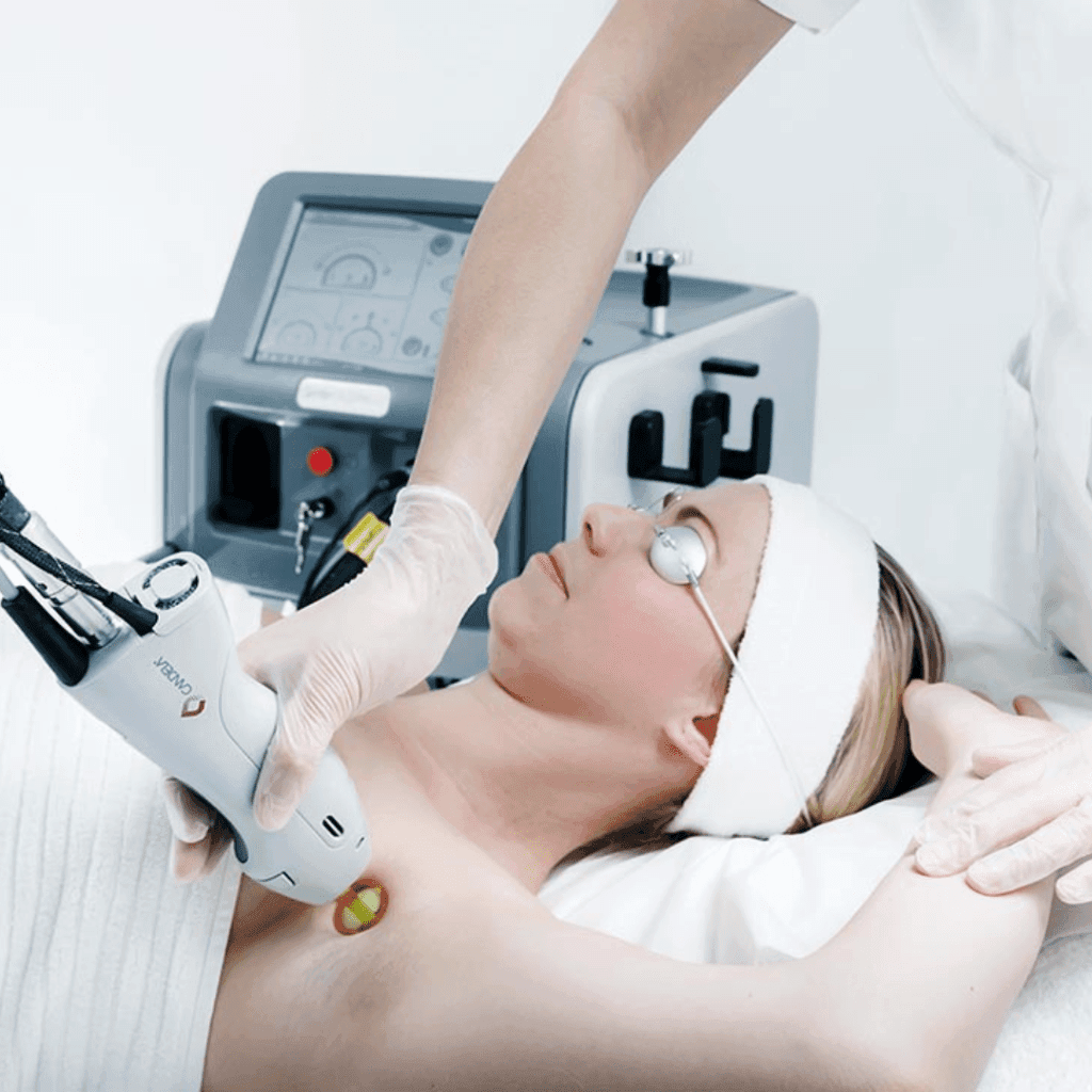 laser hair removal