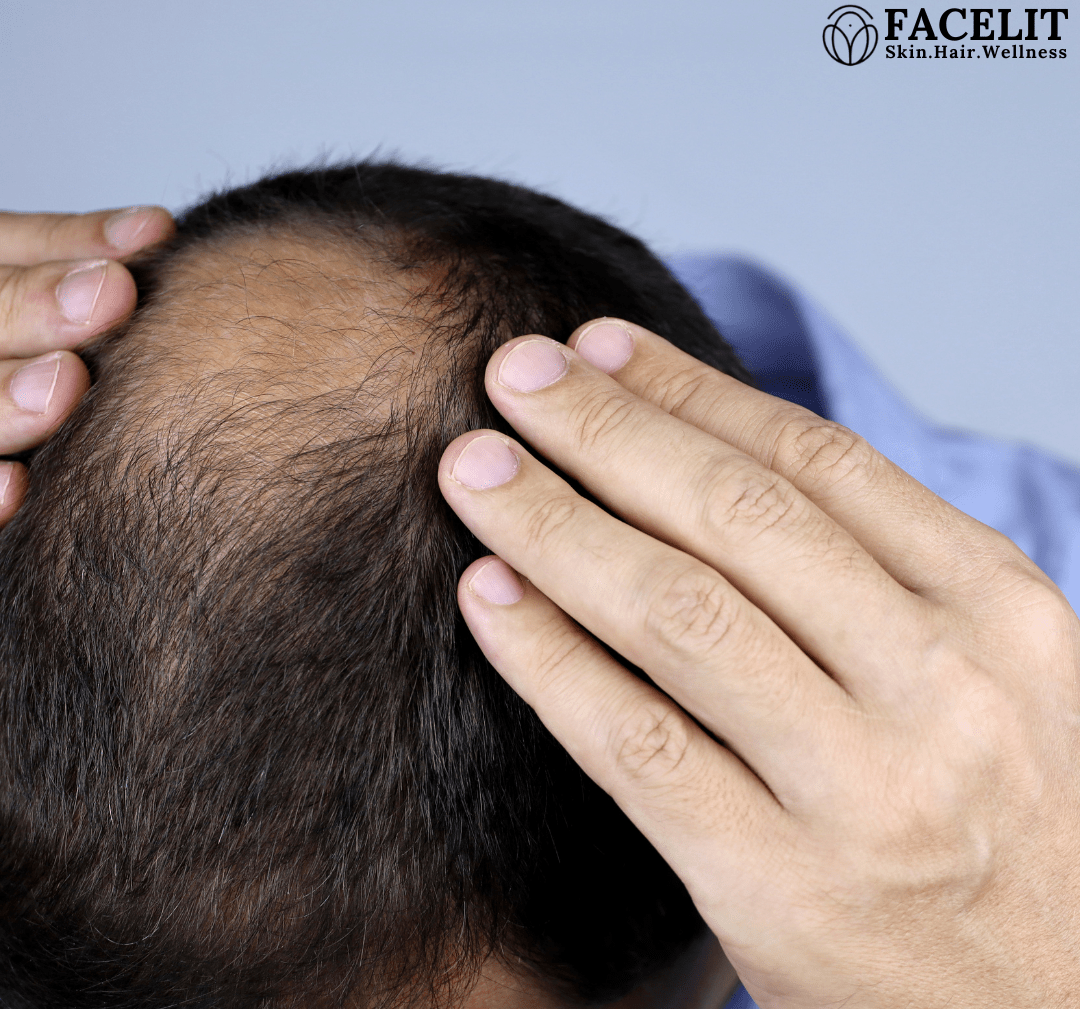 Best Hair Treatment in Jayanagar