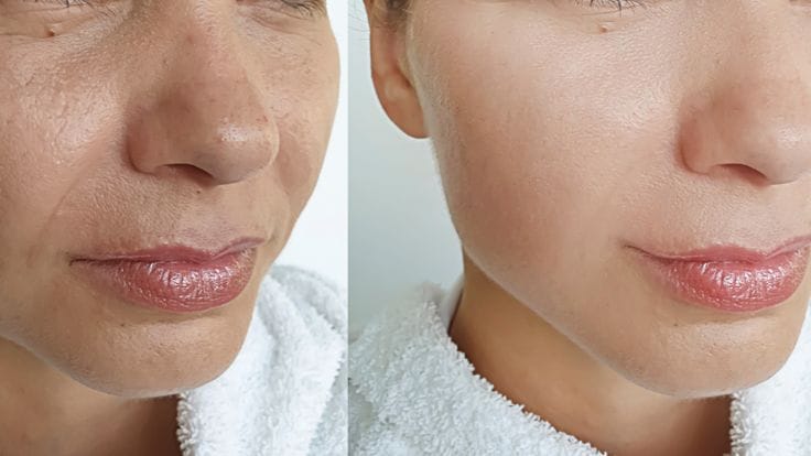 Best Profhilo Treatment in Trivandrum done at facelit clinic