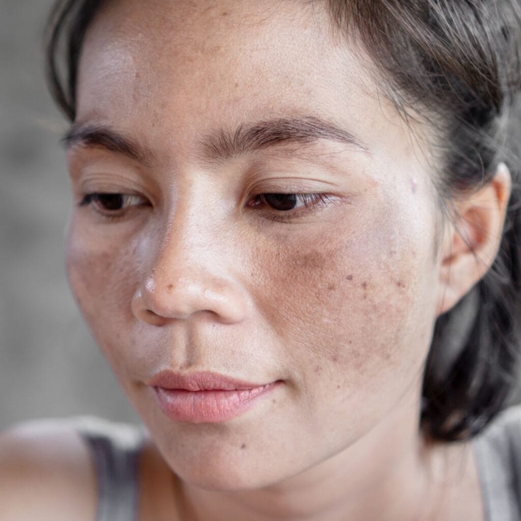 Sun Damage & Hyperpigmentation