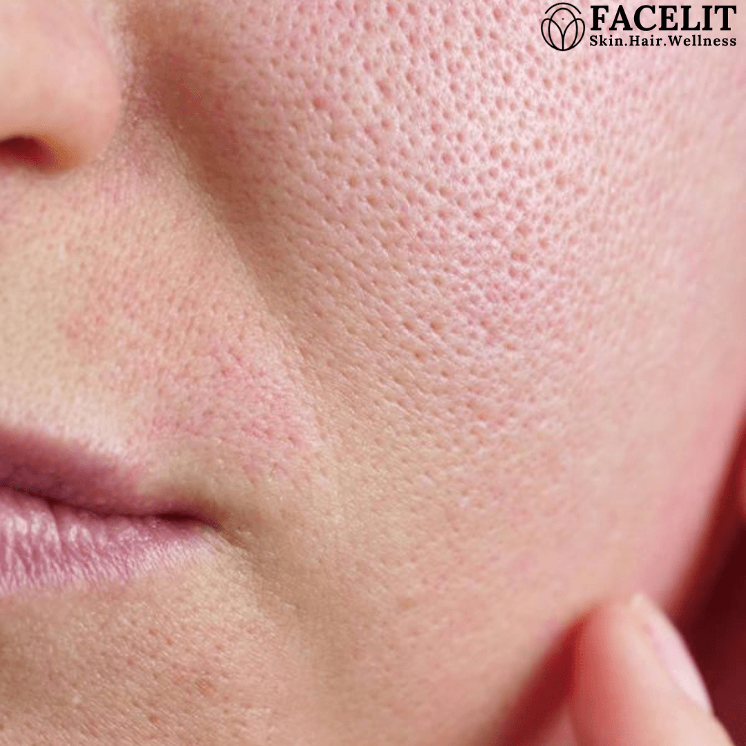 How to Get Rid of Clogged Pores
