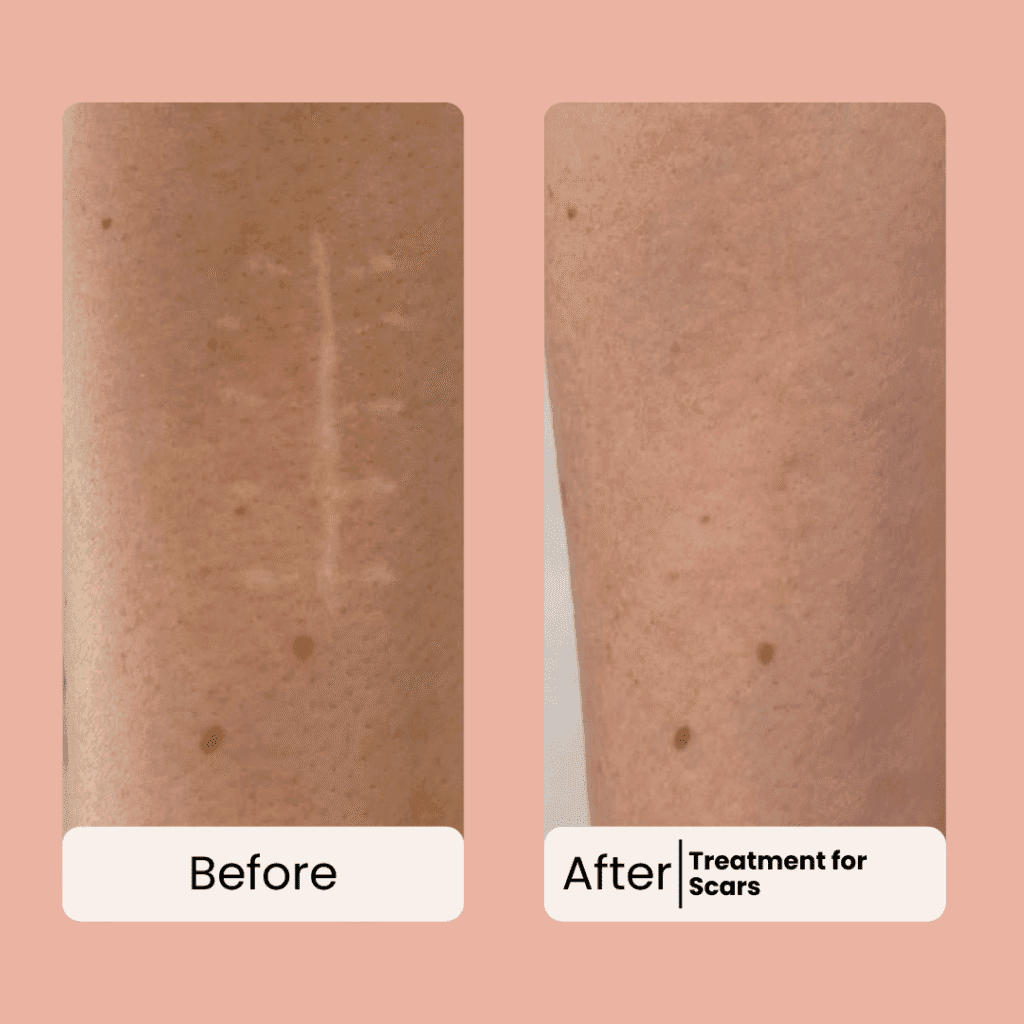 scars removal before and after