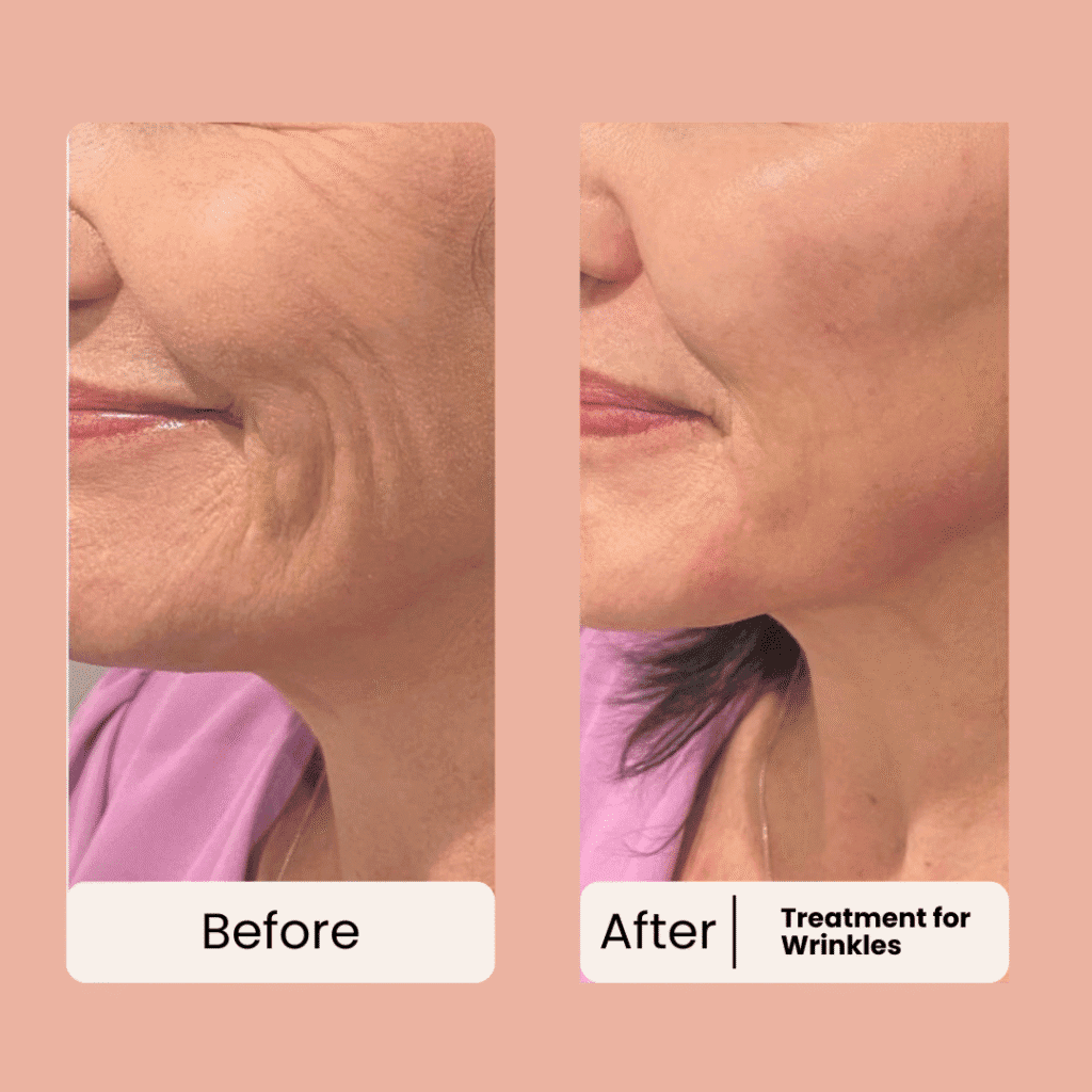 before and after for forehead wrinkles
