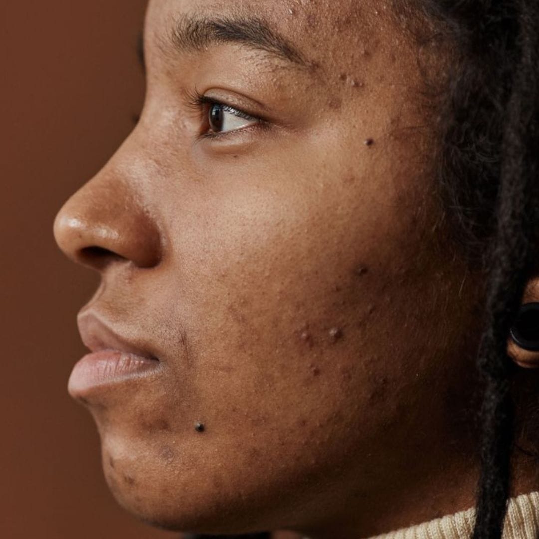 Fade acne scars on dark skin