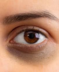 Dark Circles Causes Best Treatments in Trivandrum