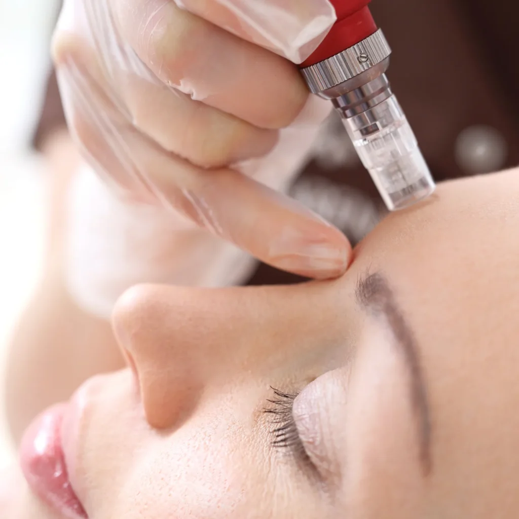 How Does Microneedling Help Rejuvenate Your Skin
