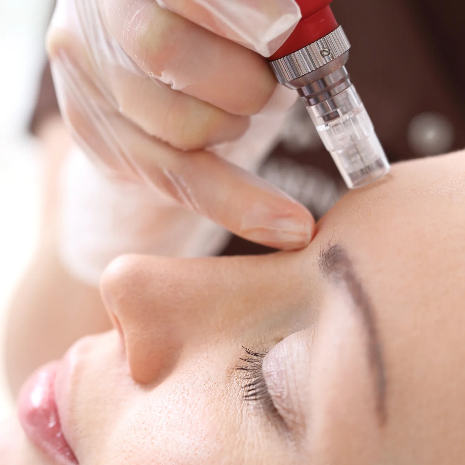 How Does Microneedling Help Rejuvenate Your Skin