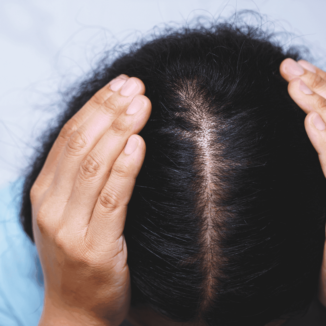 Best hair loss treatment in Coimbatore