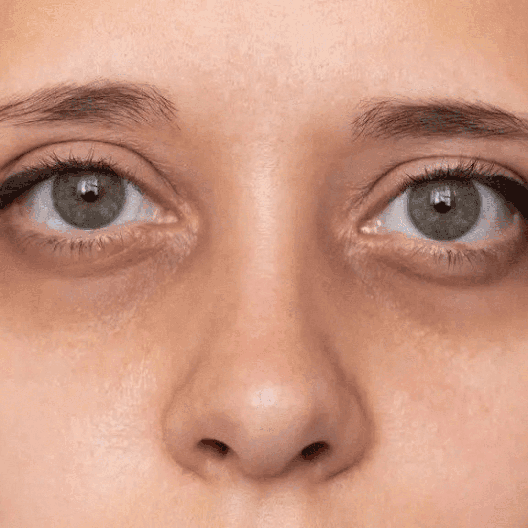 Under Eye Dark Circle Treatment in Kalyan Nagar
