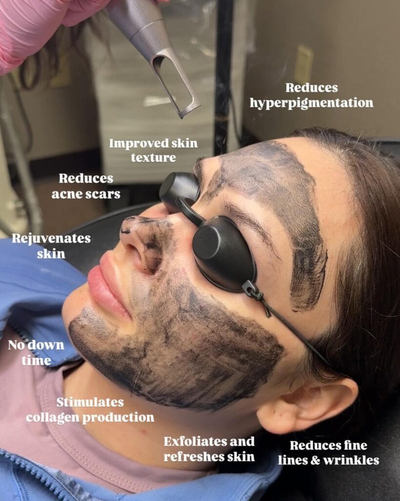 Carbon Laser Facial Cost in Bangalore