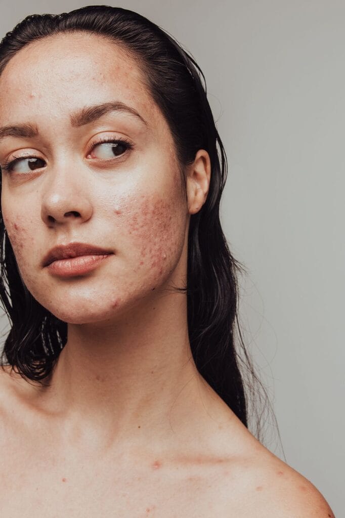 Best Acne Scar Treatment for Sensitive Skin