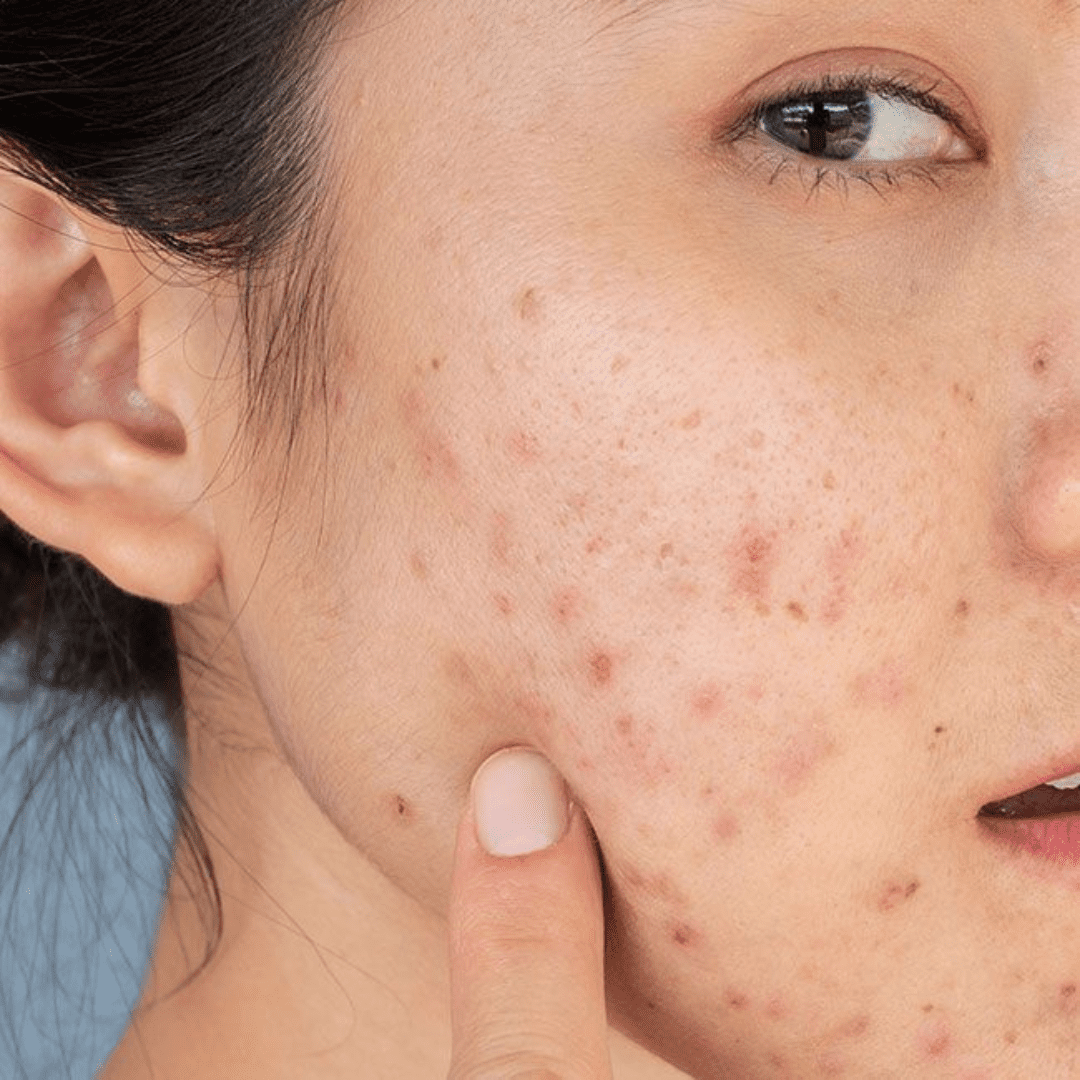 Understanding the 7 Types of Acne: Causes, Symptoms & Solutions